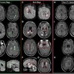 Periventricular MS lesions: Green and Red Flags