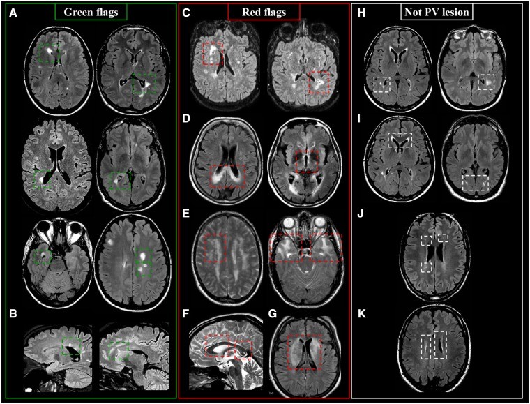 Periventricular MS lesions: Green and Red Flags