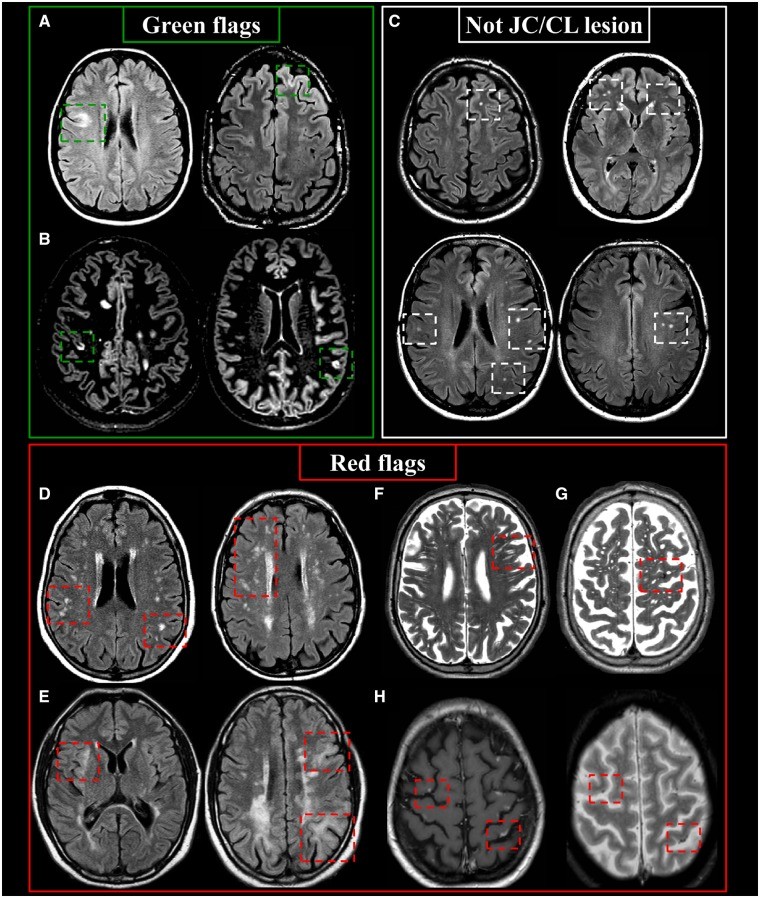 Juxtacortical/Cortical MS lesions: Green and Red Flags