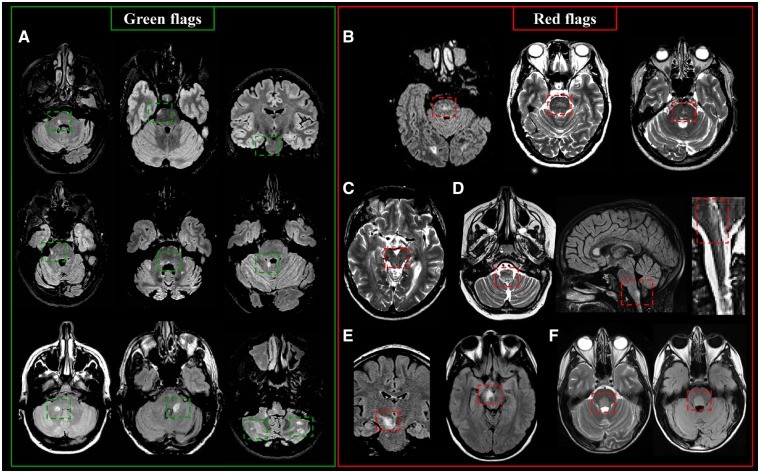 Infratentorial MS lesions: Green and Red Flags