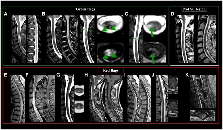 Spinal Cord MS lesions: Green and Red Flags