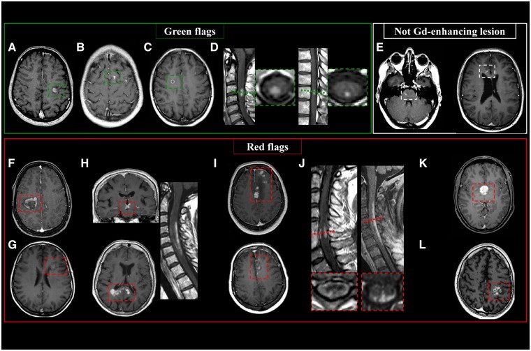 Gadolinium-Enhancing MS lesions: Green and Red Flags