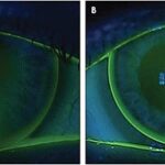 Figure 2. Bilateral lenticulated GP lens fit for aphakia, demonstrating appropriate lens centration and corneal coverage for optimal visual outcomes.