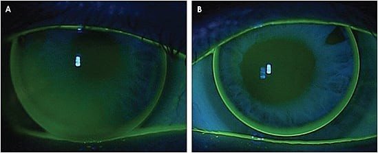 Figure 2. Bilateral lenticulated GP lens fit for aphakia, demonstrating appropriate lens centration and corneal coverage for optimal visual outcomes.