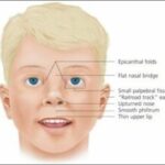 Facial features of a child with Down syndrome