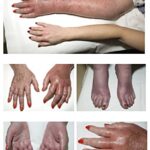 Hands and feet showing redness and pain due to Erythromelalgia