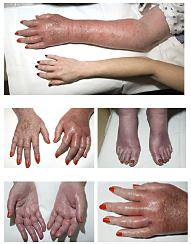 Hands and feet showing redness and pain due to Erythromelalgia