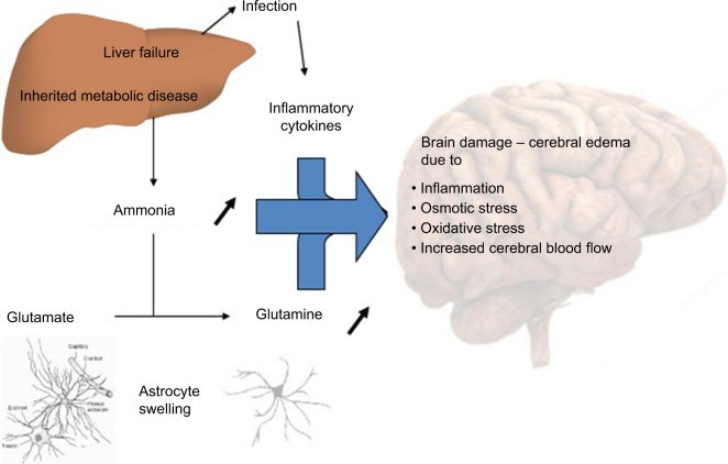 Putative mechanisms underlying hyperammonemia encephalopathy and brain edema