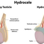 Hydrocele (right) occurs when there is a collection of fluid inside the scrotum.