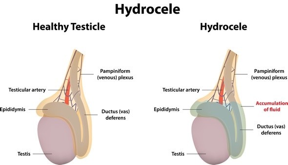 Hydrocele (right) occurs when there is a collection of fluid inside the scrotum.