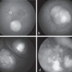 Small endophytic unifocal retinoblastoma