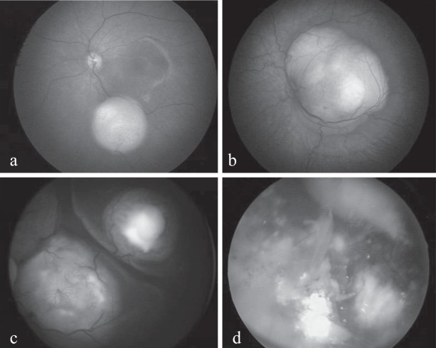 Small endophytic unifocal retinoblastoma