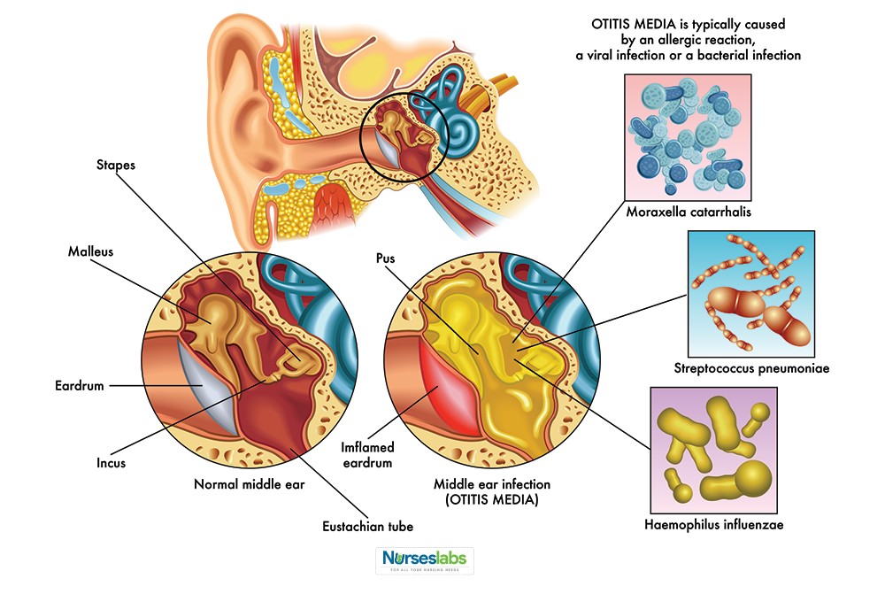 Nursing Diagnosis and Nursing Care Plan for Otitis Media