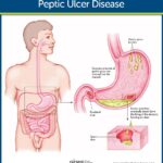 Visual representation of Peptic Ulcer Disease Pathophysiology showing erosion, damage, acid secretion and decreased resistance