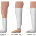 Types of arm and leg casts, including short arm, long arm, short leg, and long leg casts.