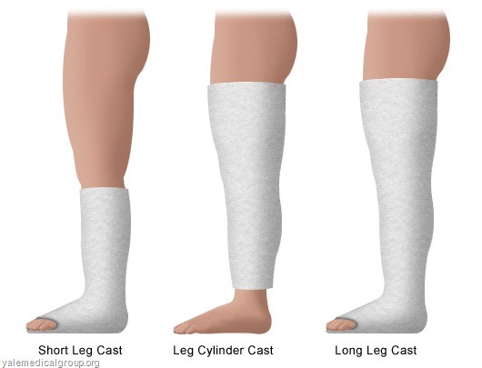 Types of arm and leg casts, including short arm, long arm, short leg, and long leg casts.